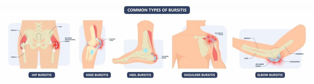 Bursitis